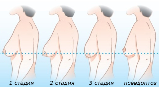 Тубулярная форма груди как выглядит